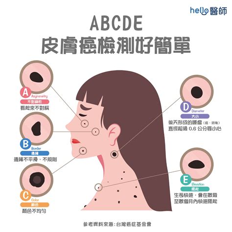 臉部 痣|痣變大、痣多或長毛會變皮膚癌？認識痣的形成與原因